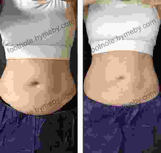 A Woman Undergoing Body Contouring Surgery Southern California Plastic Surgery Cookbook