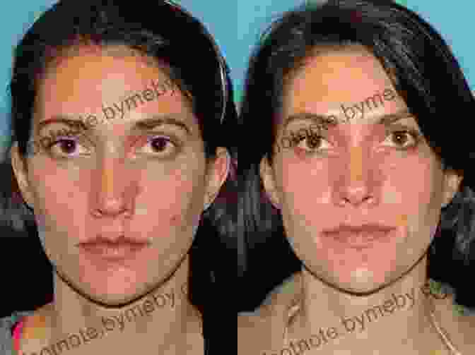 A Woman Undergoing Facial Rejuvenation Surgery Southern California Plastic Surgery Cookbook